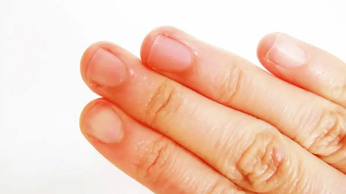 Sensação de queimação na ponta dos dedos das mãos